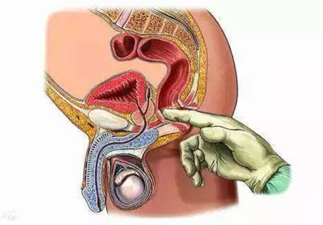八成直肠癌初诊被误判为痔疮，医生强调早期识别与诊断的重要性