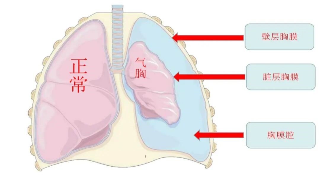 深度解析气胸，成因、症状及应对之道