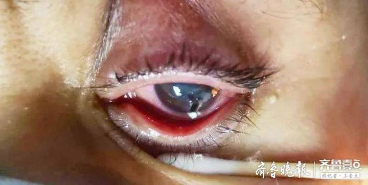 男子拆快递遭遇惊险瞬间，眼球扎入玻璃细刺，生命极限受挑战