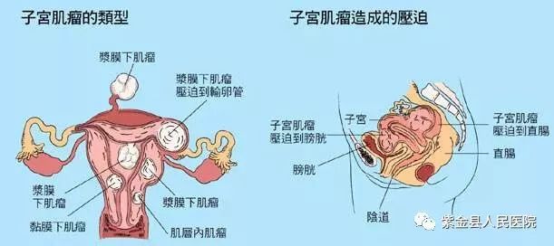 女子因情绪压抑导致子宫长瘤，揭秘情绪与健康的关联