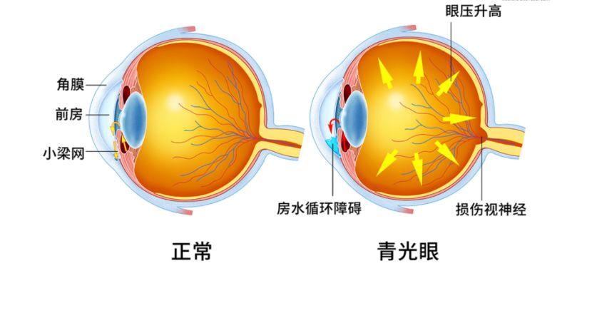 男子呕吐不止竟是青光眼，揭示疾病与症状隐秘关联之谜